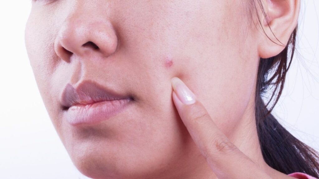 Remedies for Pimples