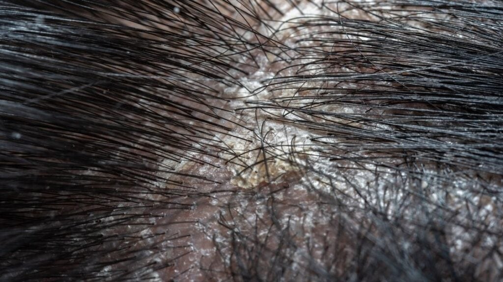 Scalp Psoriasis